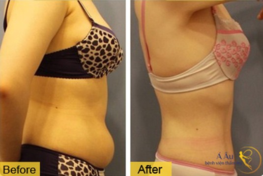 Kết quả trước và sau khi hút mỡ bụng sau sinh