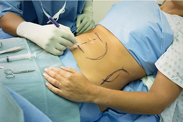Hút mỡ không phẫu thuật được đánh giá là phương pháp hiệu quả và an toàn