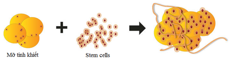 Bơm mỡ vào mí mắt bằng StemCell tế bào mỡ tự thân