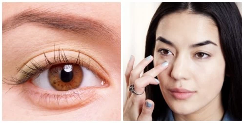 Phẫu thuật lấy mỡ mí mắt dưới an toàn - 1 1 6 1