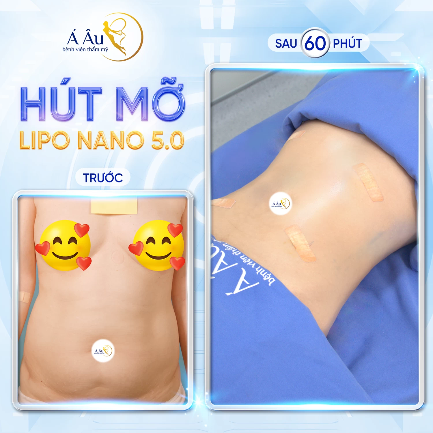 Thực hiện hút mỡ bụng bằng công nghệ Lipo Nano 5.0 mang đến kết quả tức thì mà không làm tổn thương cơ thể
