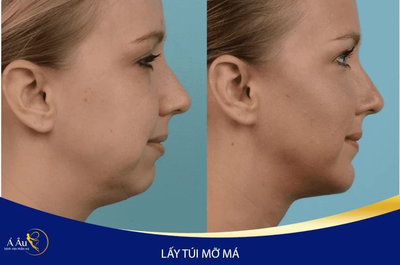 Hủy mỡ nọng cằm không phẫu thuật - 2