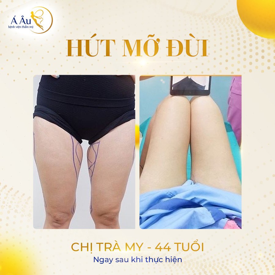 Hiệu quả giảm mỡ ngay sau khi hút mỡ đùi