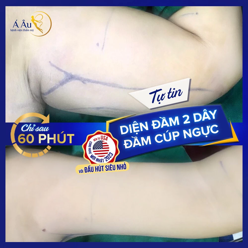Tự tin diện đồ cúp ngực sau khi hút mỡ vùng nách