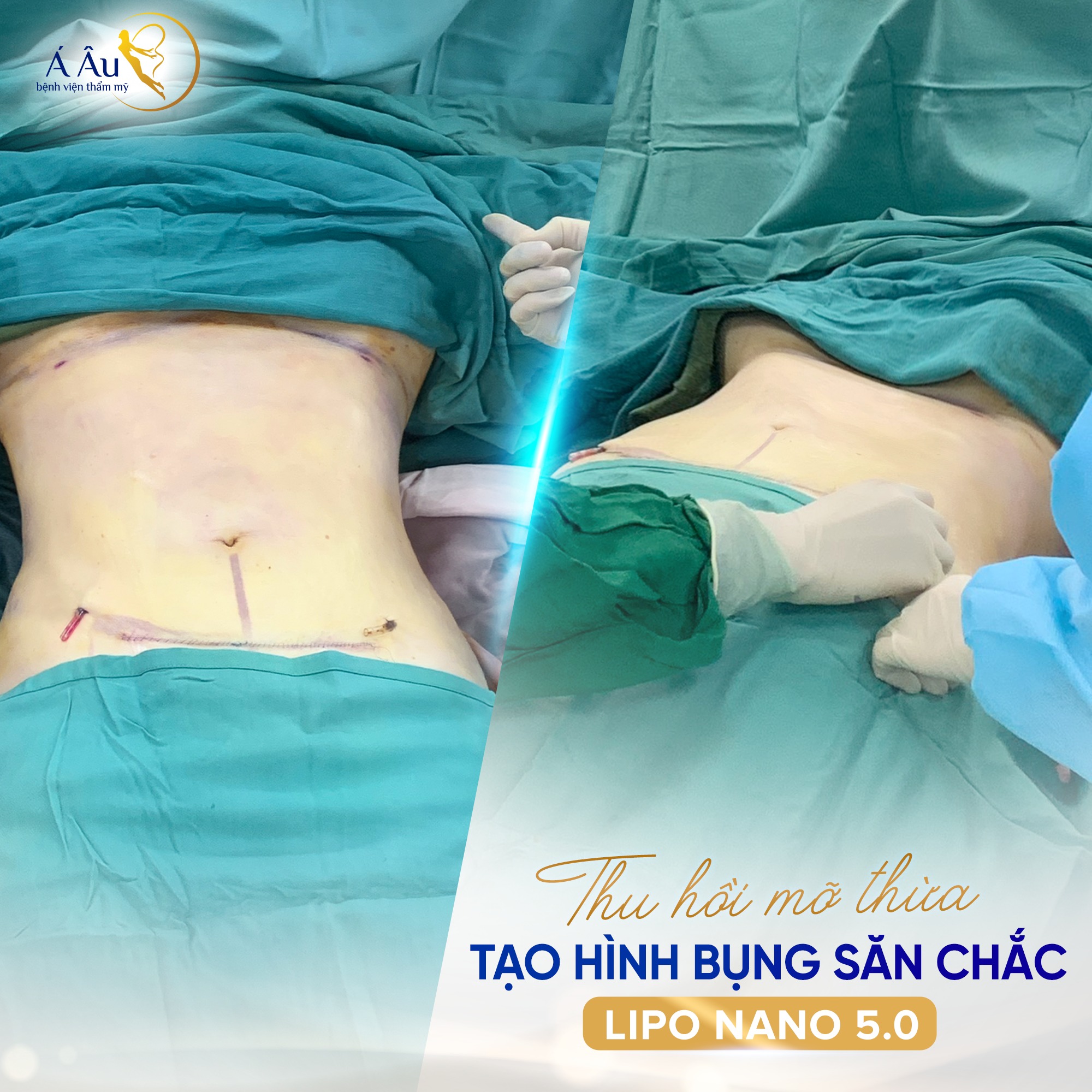 Thu hồi mỡ thừa - Tạo hình bụng săn chắc với Lipo Nano 5.0