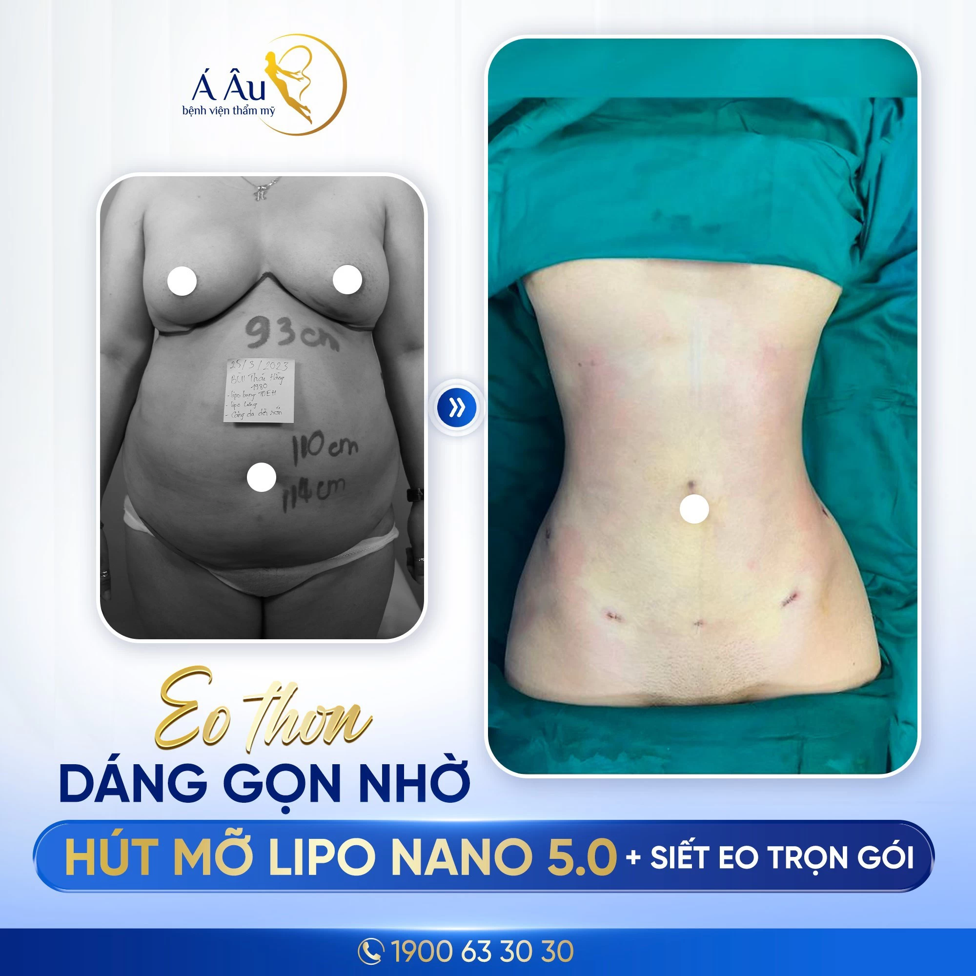 Eo thon dáng gọn nhờ hút mỡ bụng toàn phần Lipo Nano 5.0 