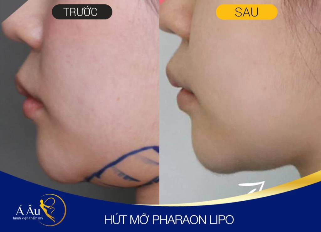Hủy mỡ nọng cằm không phẫu thuật - B A 2019 HUT MO 2