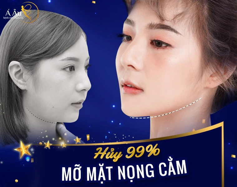 Hủy mỡ nọng cằm không phẫu thuật - BaiViet hut mo nong cam 1