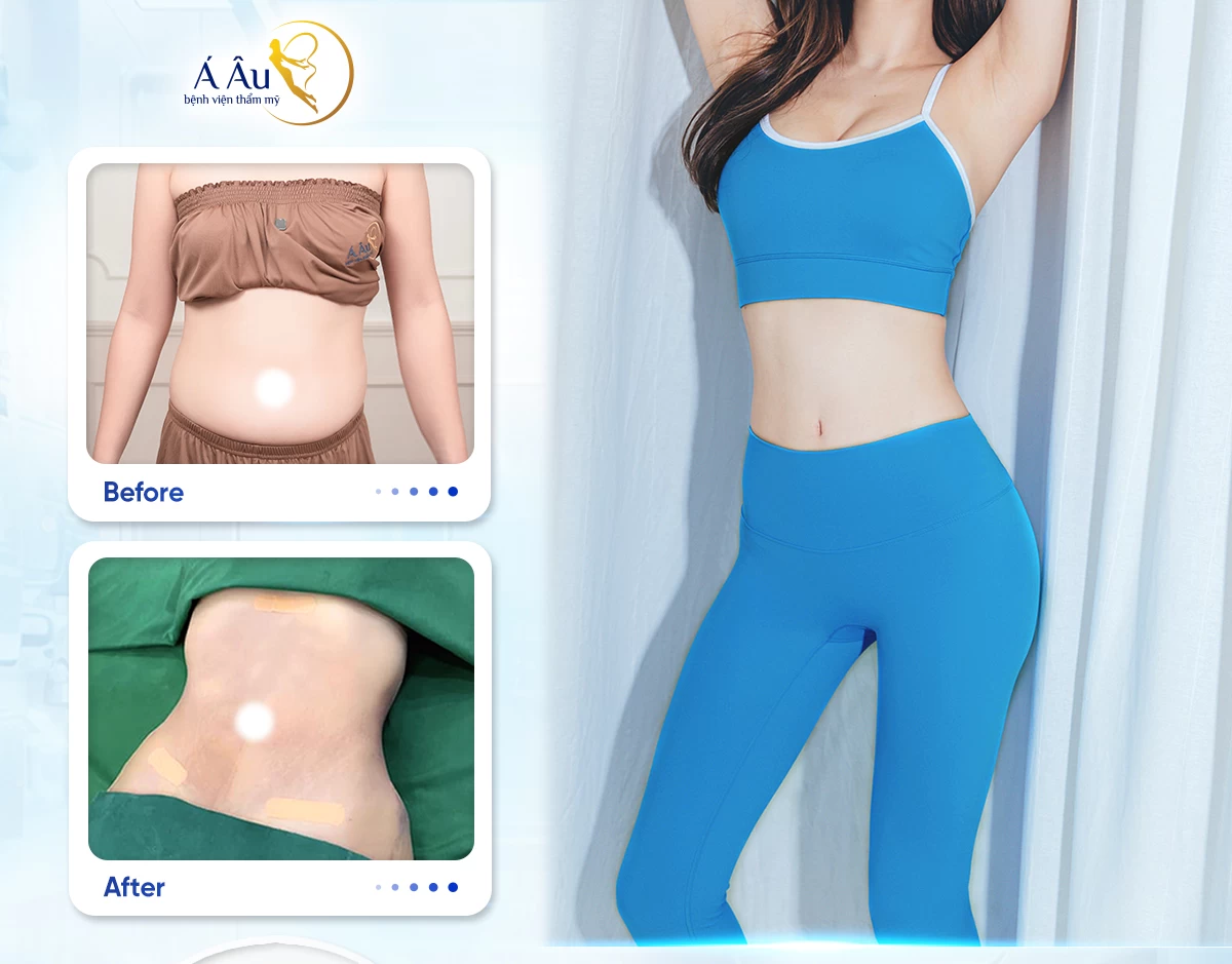 Hút mỡ bụng toàn phần Lipo Nano 5.0 – Giảm mỡ, kiến tạo eo thon dáng ngọc 17 Hút mỡ bụng toàn phần Lipo Nano 5.0 - Giảm mỡ, kiến tạo eo thon dáng ngọc - Banner hut mo Trang 2 edit
