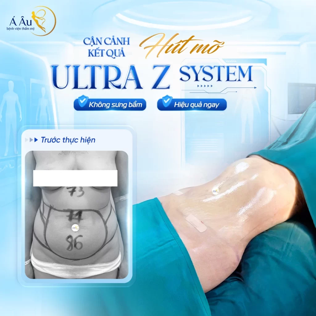 Trang chủ 2026 - Hinh anh thuc te khach hang hut mo Ultra Z System 1
