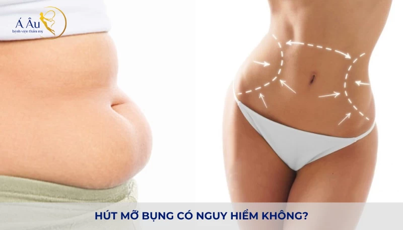 Hút mỡ bụng có nguy hiểm không? - Hut mo Lipo Nano 5.0 3 1