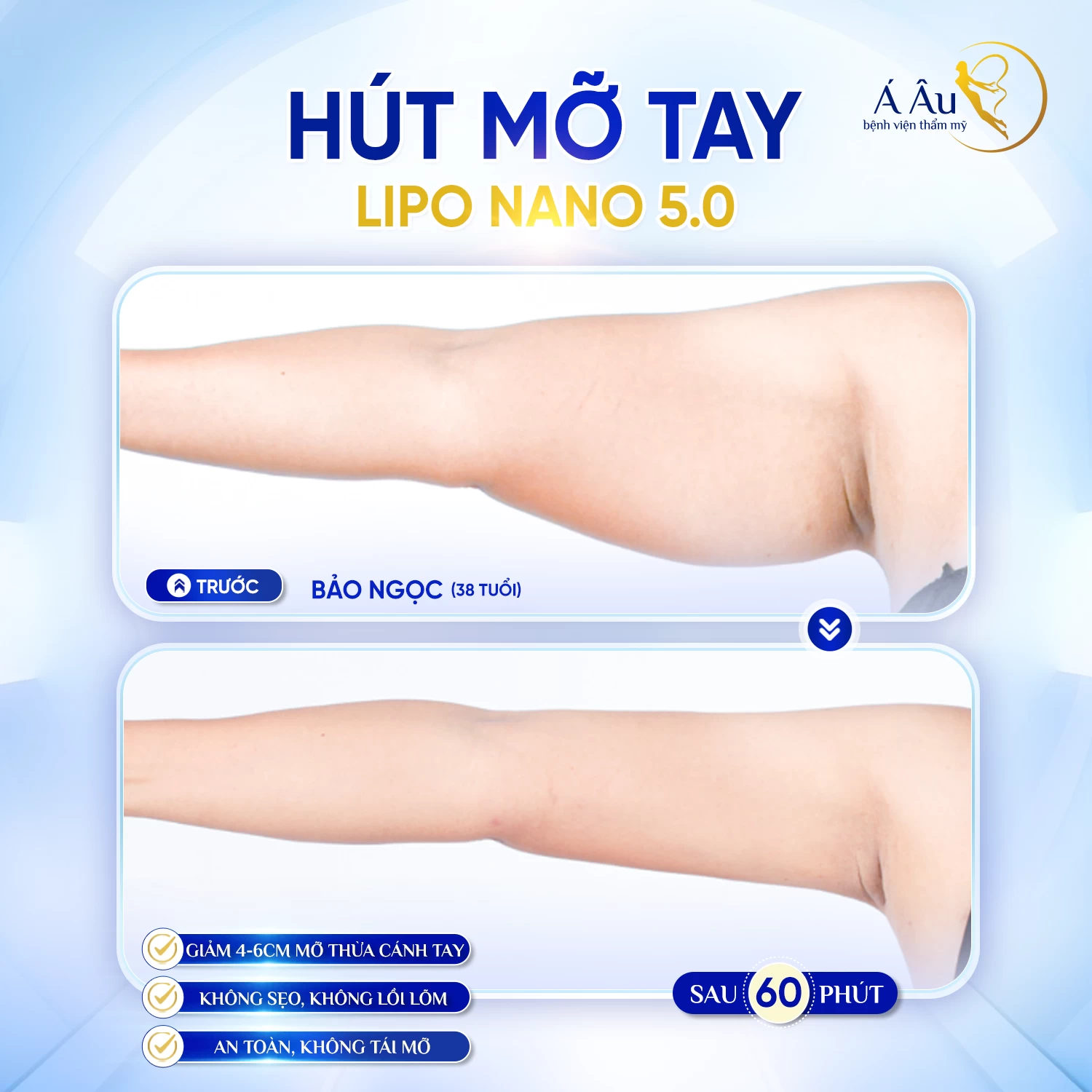 Thoát kiếp cánh tay "lực điền" sau 60 phút với công nghệ hủy mỡ không phẫu thuật Lipo Nano 5.0