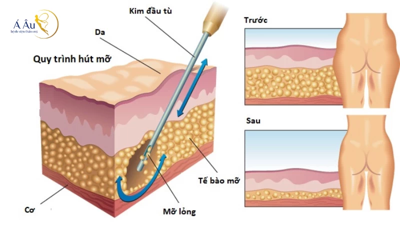 Lưu ý trước khi lựa chọn hút mỡ toàn thân ở đâu an toàn và uy tín nhất