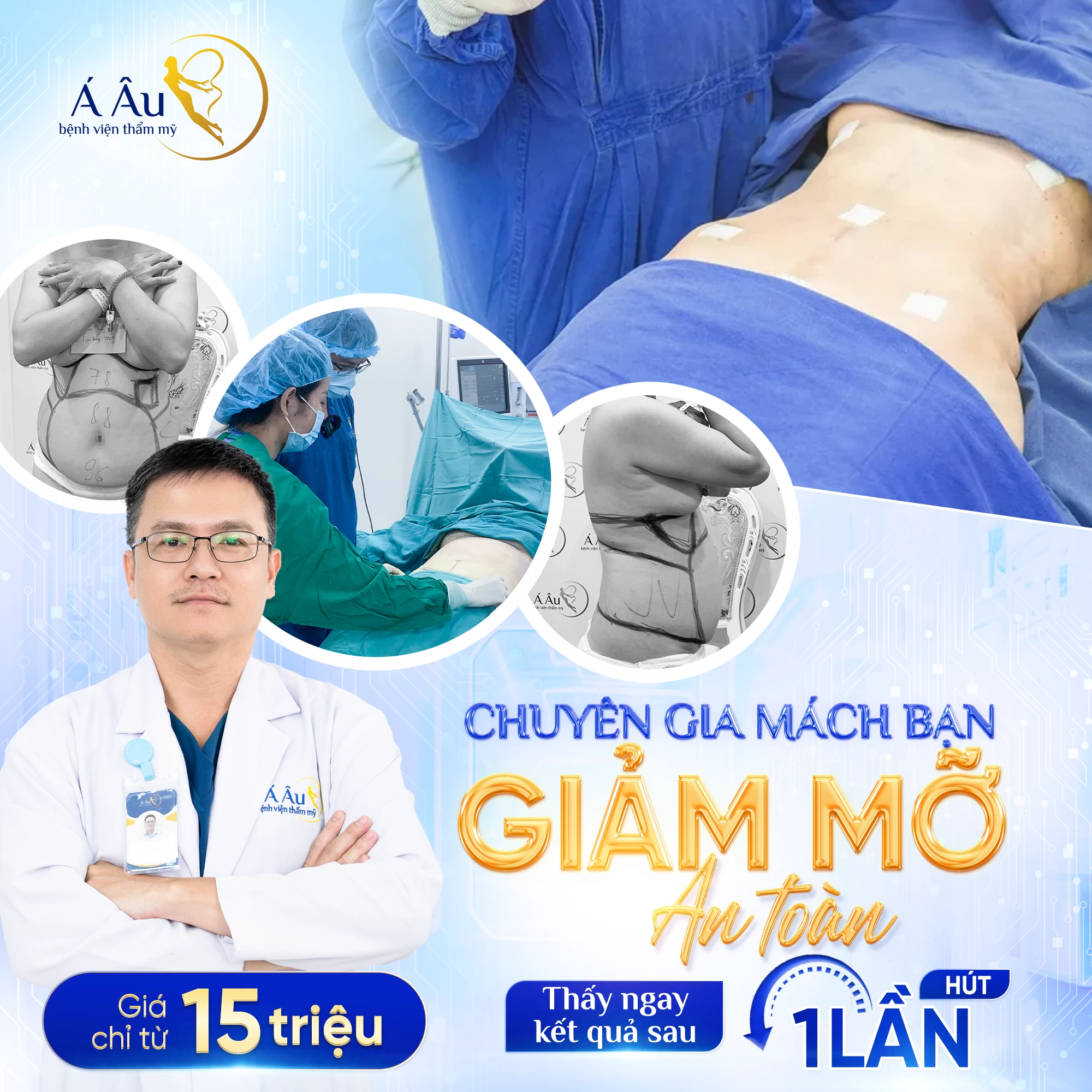 Thoát kiếp cánh tay "lực điền" sau 60 phút với công nghệ hủy mỡ không phẫu thuật Lipo Nano 5.0