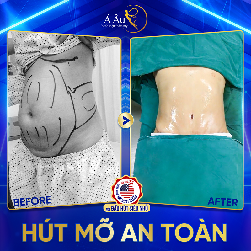 Thực hiện hút mỡ bụng bằng côngnghệ Lipo Nano 5.0 mang đến kết quả tức thì mà không làm tổn thương cơ thể