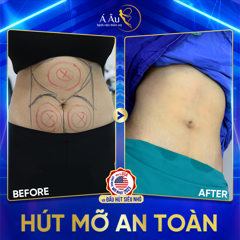 Hình ảnh thực tế khách hàng sau khi hút mỡ bụng tại Bệnh viện Á Âu