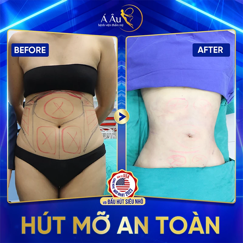 Kết quả thực tế sau khi hút mỡ bụng phụ thuộc vào từng cơ địa của mỗi người