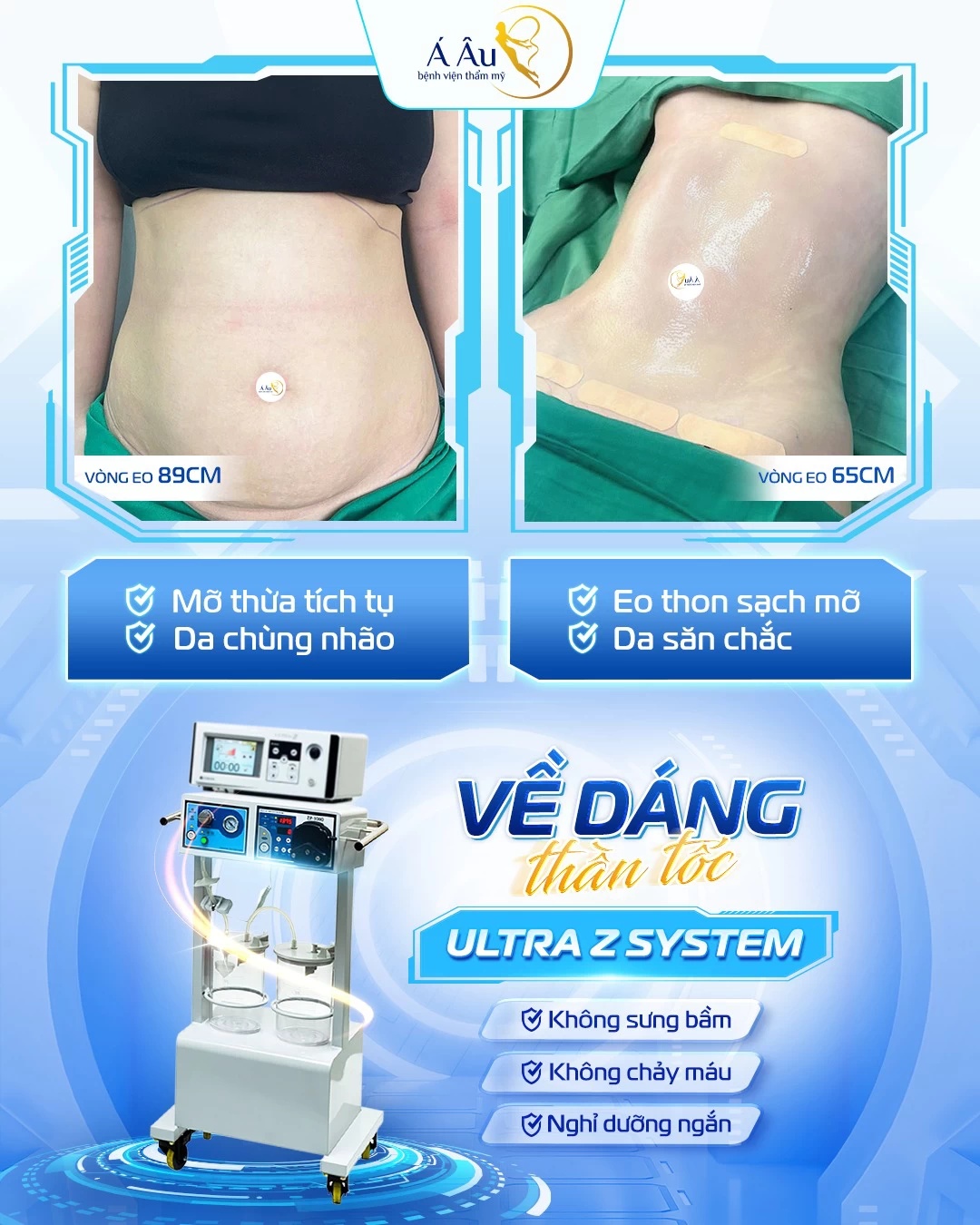 Hình ảnh thực tế của khách hàng sau Hút mỡ