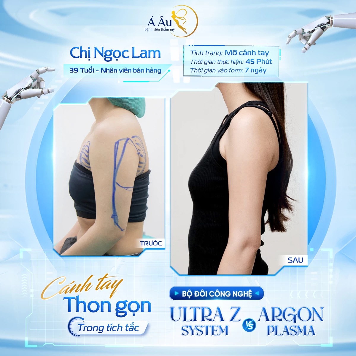 Hình ảnh thực tế của khách hàng sau Hút mỡ