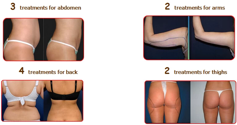 Hút mỡ bằng laser lipo Pharaon giải quyết mỡ thừa hiệu quả - cach hut mo bung sau tet 3