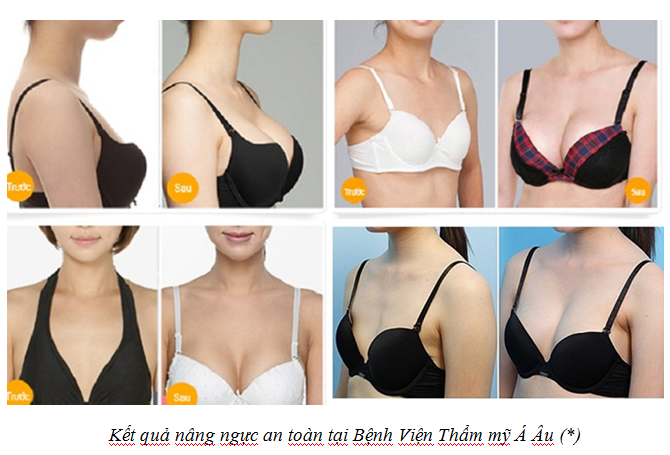 Hút mỡ bụng nâng ngực - Giải pháp nâng ngực tự nhiên - cach nang nguc tu nhien3