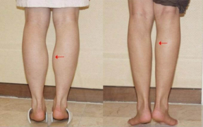 Loại bỏ mỡ bắp chân nhanh chóng