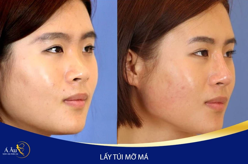 Hủy mỡ nọng cằm không phẫu thuật - ewre 1