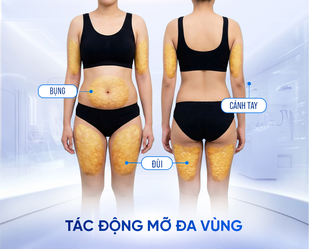 Tác động mỡ da vùng Hút mỡ Argon 360 tại Bệnh viện Á Âu