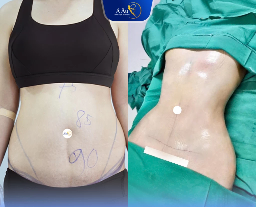 kết quả hút mỡ Argon 360 tại Bệnh viện Á Âu