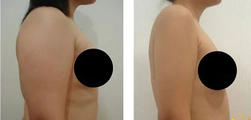 Hình ảnh hút mỡ bụng tại Bệnh viện thẩm mỹ Á Âu - hut mo bang pharaon lipo new 2