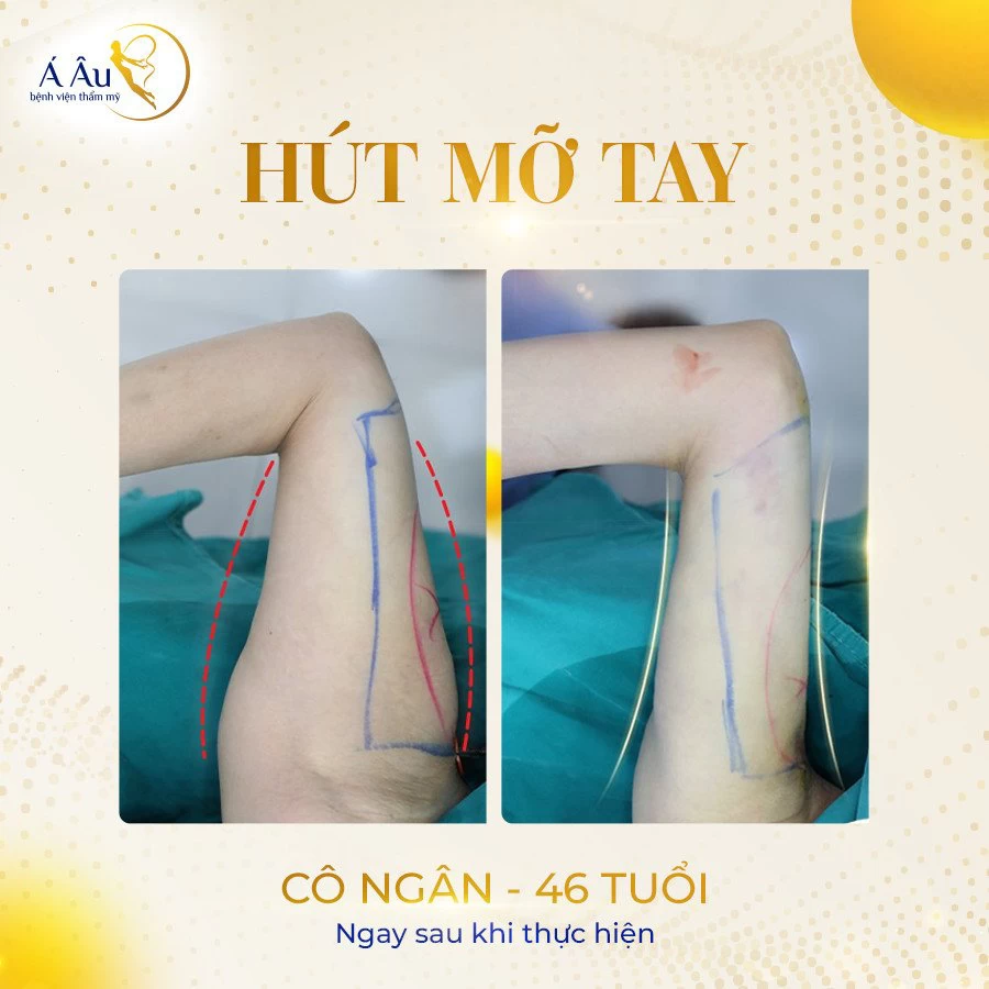 Cô Ngân khách hàng hút mỡ bắp tay thành công tại Bệnh viện Thẩm mỹ Á Âu