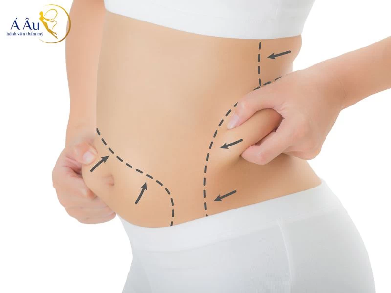 Hút mỡ bụng là phương pháp sử dụng kỹ thuật hút để loại bỏ chất béo vùng bụng