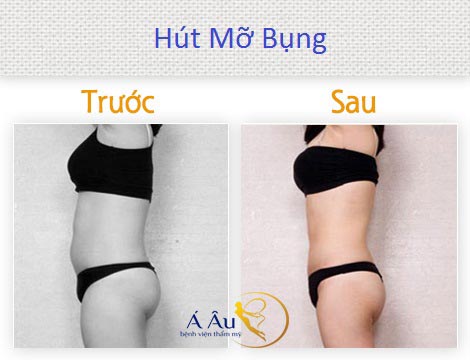 Hút mỡ bụng giá bao nhiêu ? Giải đáp từ bác sĩ thẩm mỹ hút mỡ bụng 27 Hút mỡ bụng trước và sau