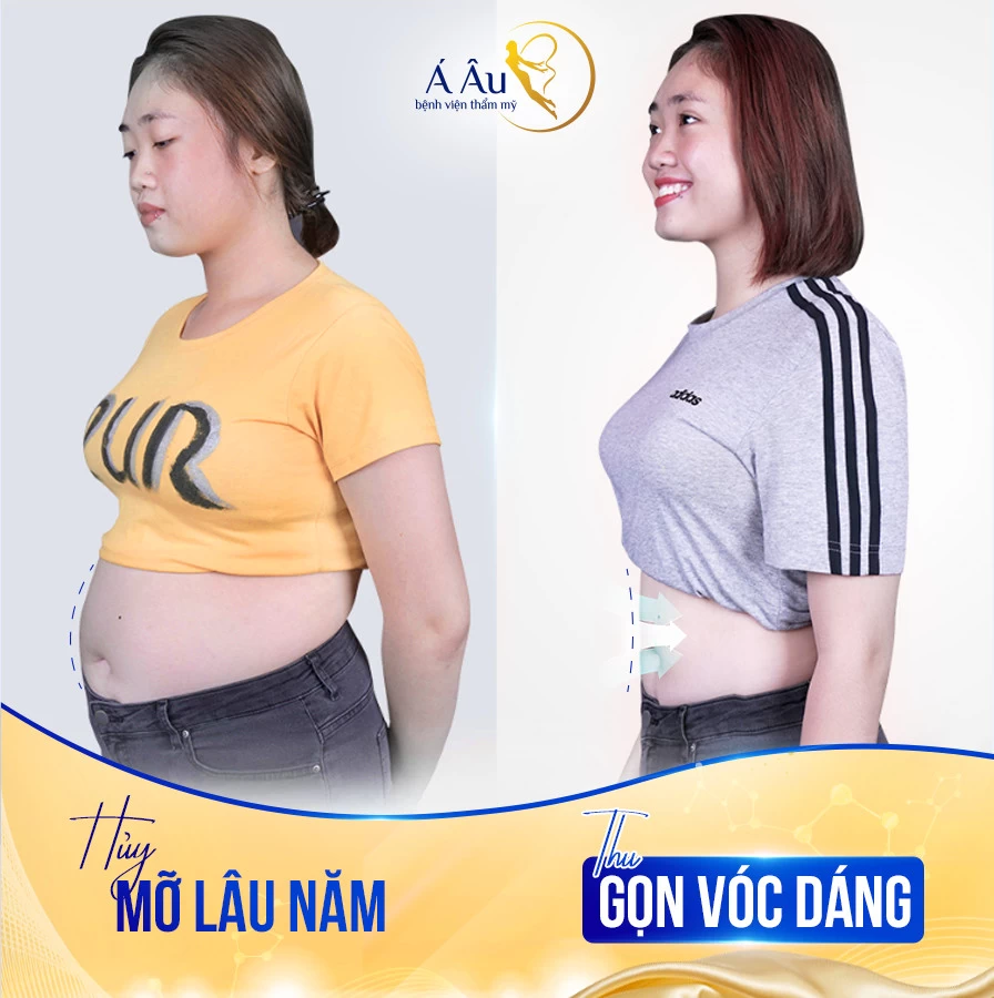 Hình ảnh thực tế khách hàng đã thực hiện dịch vụ hút mỡ bụng Lipo Nano 5.0 thành công