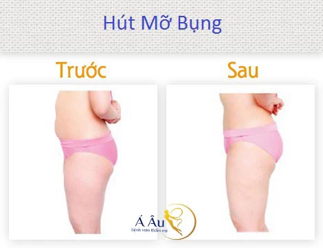Hút mỡ bụng giá bao nhiêu ? Giải đáp từ bác sĩ thẩm mỹ hút mỡ bụng 28 Khách hàng điều trị hút mỡ bụng cho kết quả nhanh chóng tại Bệnh Viện Á Âu