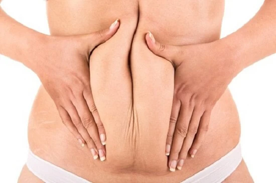 hút mỡ bụng căng da