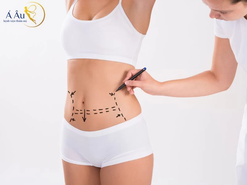 Hút mỡ bụng là phương pháp thẩm mỹ, sử dụng các công nghệ hiện đại để loại bỏ lượng mỡ thừa bên trong cơ thể nhanh chóng