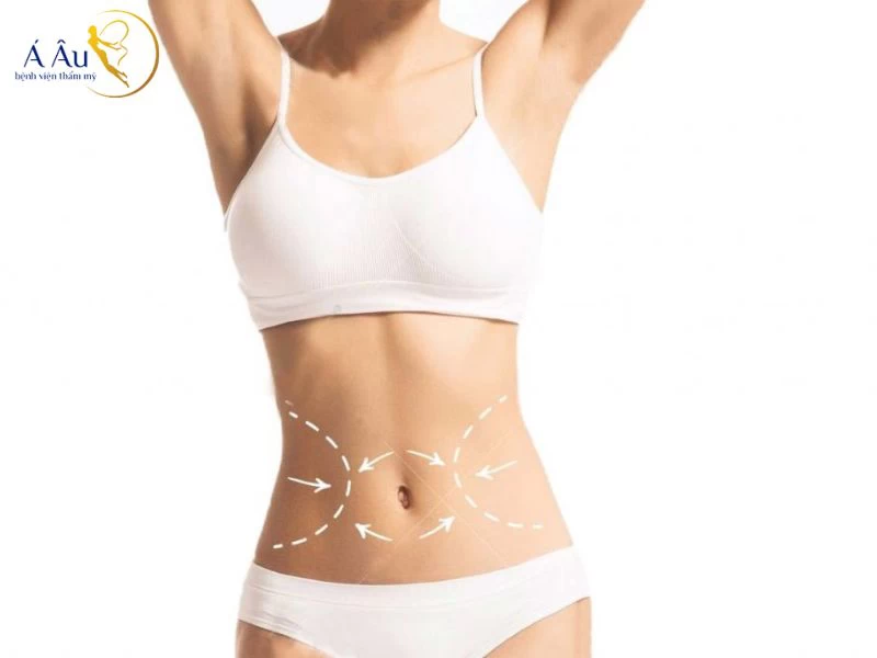 Hút mỡ bụng làliệu pháp giảm cân hiện đại được nhiều chị em tin chọn