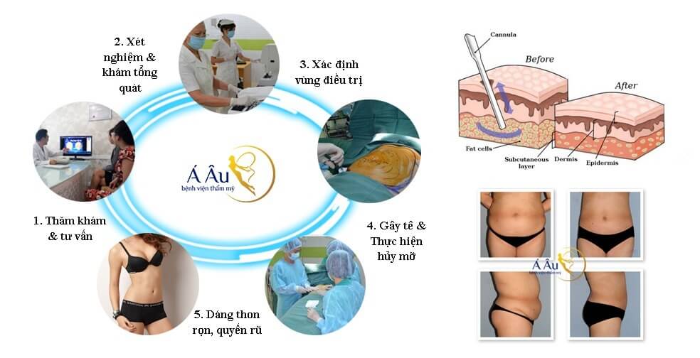 Quy trình hút mỡ bụng với Dr Hào đạt chuẩn của Bộ Y tế