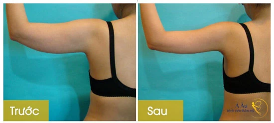 Loại Bỏ 99% Mỡ Bắp Tay Với 1 Lần Hút Mỡ - hut mo canh tay giam duoc.