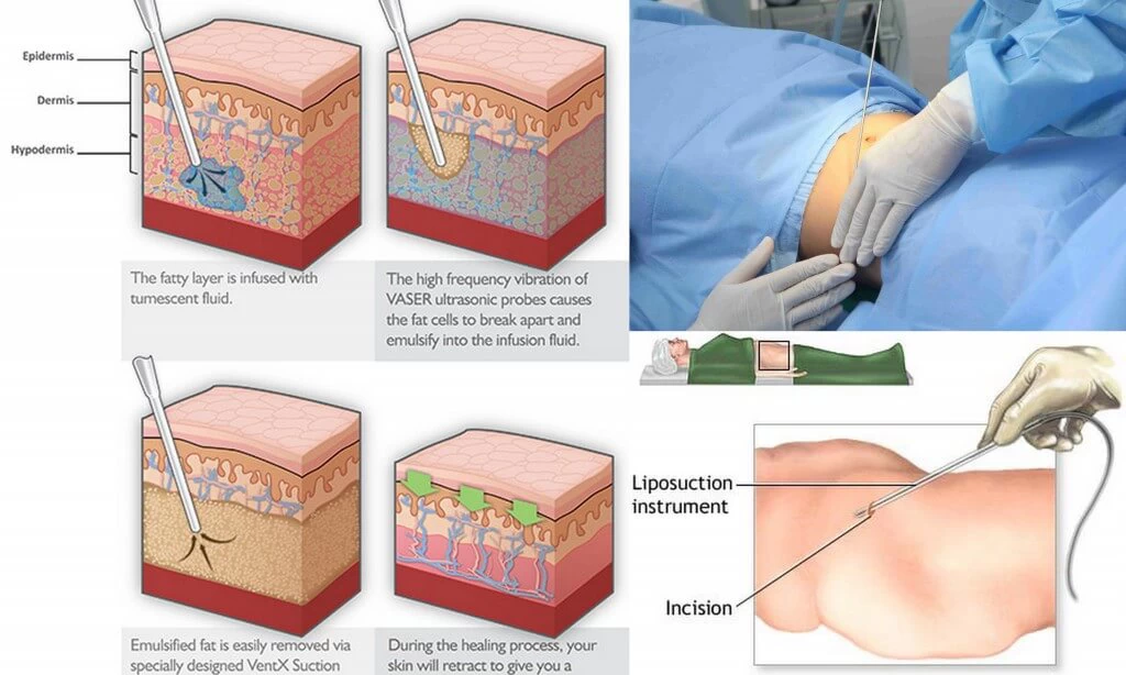 Hút mỡ Pharaon Lipo được khách hàng tin tưởng nhất hiện nay