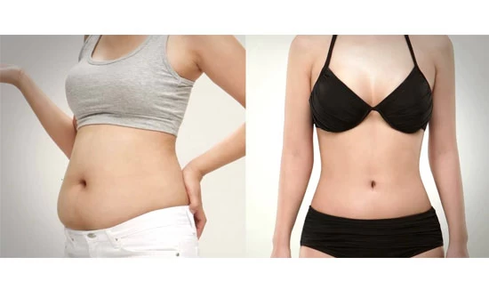 Hút mỡ bụng tại bệnh viện Thu Cúc có an toàn không? 13 Hút mỡ bụng cho khách hàng thân hình quả táo