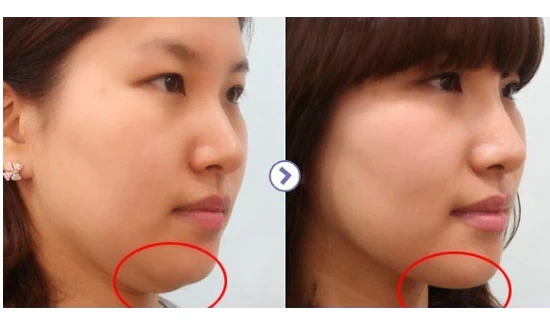 Hút mỡ cằm gia bao nhieu? Có hiệu quả như ý và nhanh chóng không? 10 Hút mỡ cằm gia bao nhieu? Có hiệu quả như ý và nhanh chóng không? - hut mo hieu qua tung dang nguoi 9