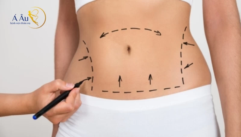 Đối Tượng Thực Hiện Hút Mỡ Hông Eo