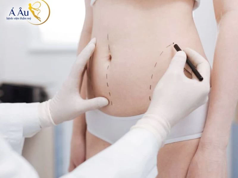 Bách sĩ vẽ định hình trước khi tiến hành hút mỡ