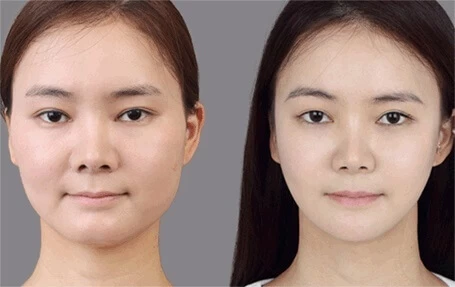 Hút mỡ mặt có đau không? - hut mo mat