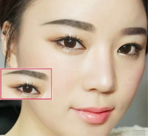 Hút mỡ mắt bụp trả lại đôi mắt tươi sáng trẻ trung - hut mo mat bup 1