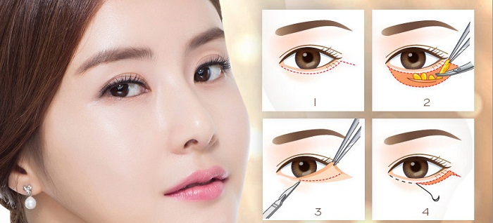 hút mỡ mí mắt dưới