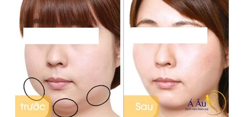Hủy mỡ mặt, hủy mỡ nọng cằm