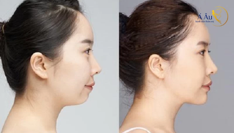 Hút mỡ nọng cằm nguy hiểm không?